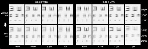 Simulated vision chart seen through the refractive statuses of − 3.00 D ...