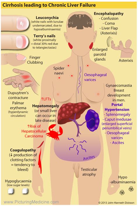 Liver Cirrhosis Symptoms Skin