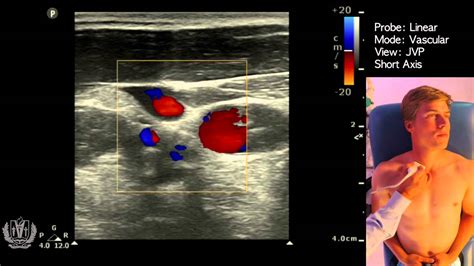 JVP (Jugular Venous Pulsation) Evaluation using Ultrasound - YouTube