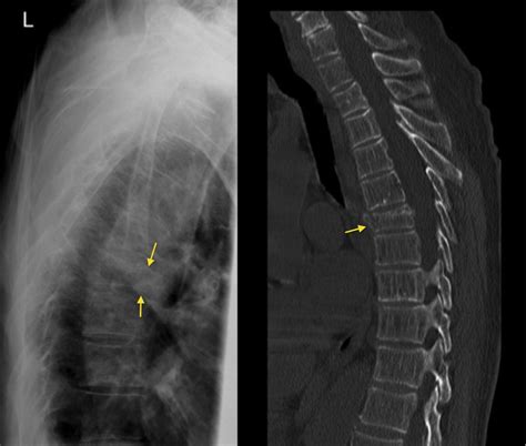 Thoracic spine fracture - Radiology at St. Vincent's University Hospital