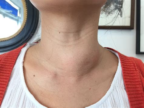 Thyroid Goiters With Nodules 101: – Thyroid Center of Santa Monica