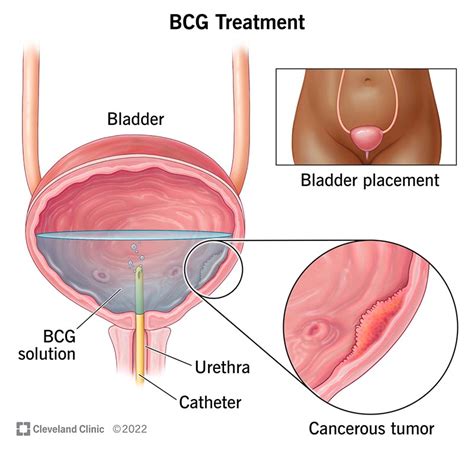 Bladder Cancer Tumor Removal