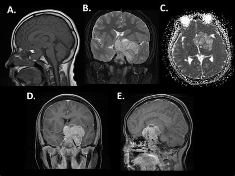 Prolactinoma Surgery