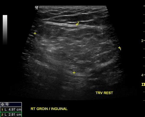 Scrotal Hernia Ultrasound