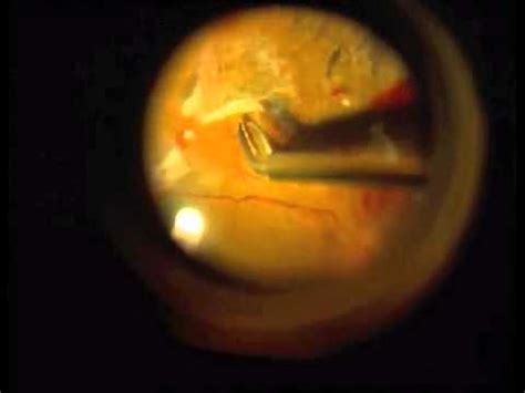 Vitrectomy in proliferative diabetic retinopathy - YouTube