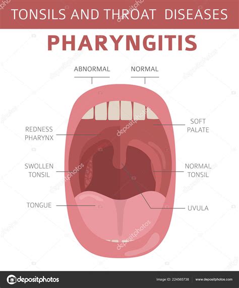 Tonsils Throat Diseases Pharyngitis Symptoms Treatment Icon Set Medical ...