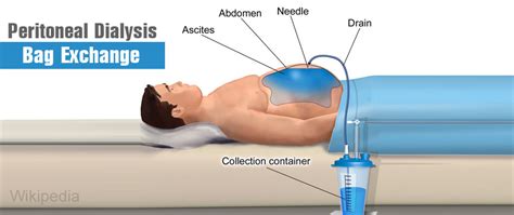 Peritoneal Dialysis Solution