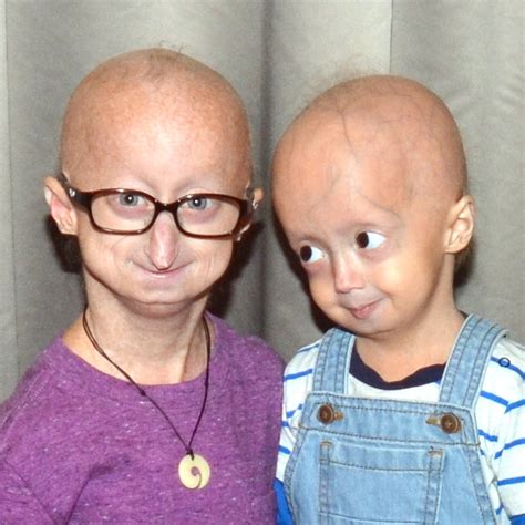 Progeria | Science-Based Medicine