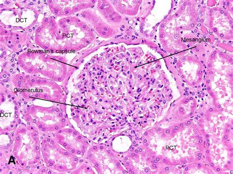 American Urological Association - Kidney: Renal Corpuscle (Glomerulus ...