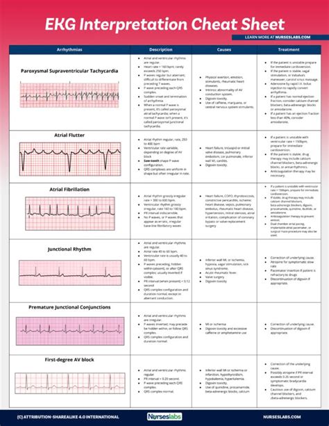 EKG Interpretation Cheat Sheet