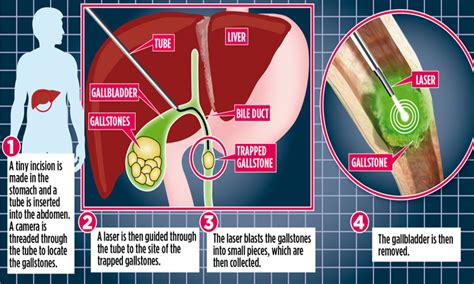 Gallbladder Stones Operation Video