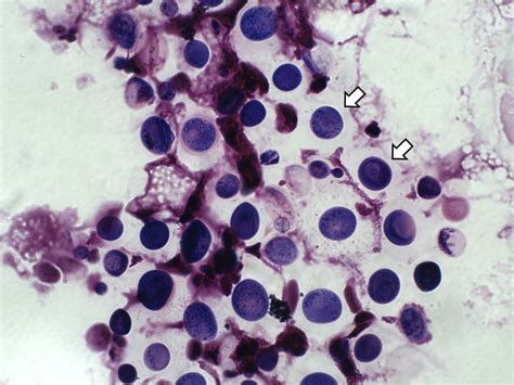 Cryptococcus Neoformans Gram Stain