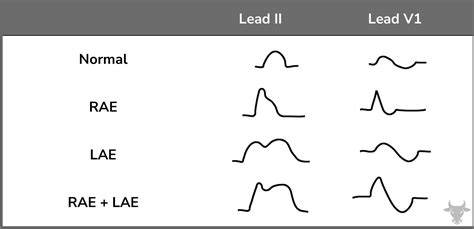 Left Atrial Enlargement | ECG Stampede