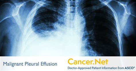 Fluid Around the Lungs or Malignant Pleural Effusion | Cancer.Net