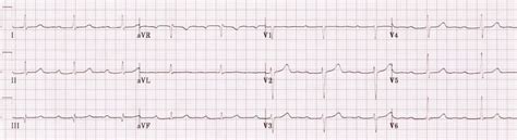 First Degree Heart Block • LITFL • ECG Library Diagnosis