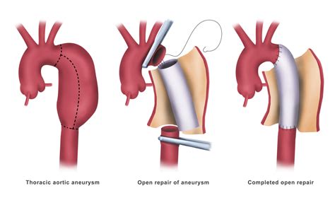 Open Aortic Surgery for Aneurysms - Dubai - Dr. Ahmed Farah