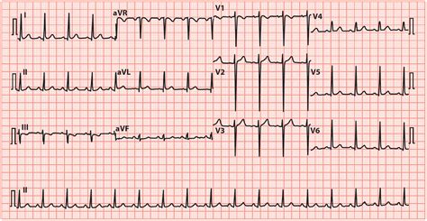 Left Ventricular Hypertrophy (LVH): How to Recognize it on ECG [With ...