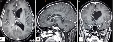 MRI of brain with contrast demonstrates no recurrence of tumor and ...