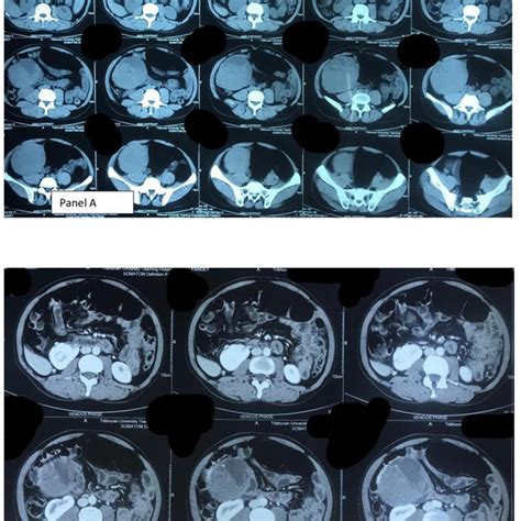 CECT abdomen pelvis axial images (Panel A -Non contrast images and ...