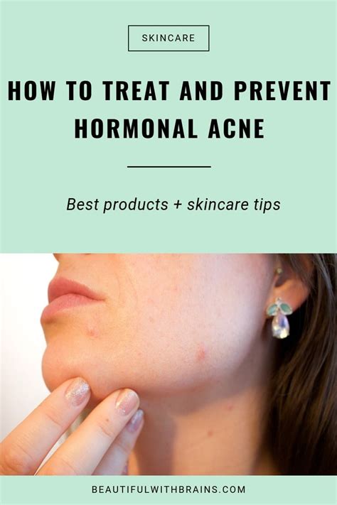 The Ultimate Guide To Dealing With Hormonal Acne