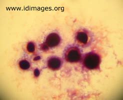 Cryptococcus Images - Infectious Disease Images - eMicrobes Digital ...