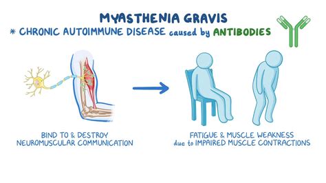 Myasthenia gravis: Nursing - Osmosis Video Library