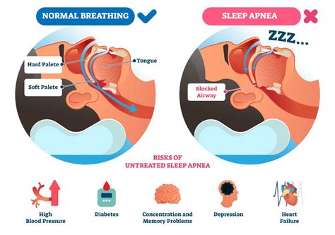 Sleep Apnea | Lakeside Medical Supplies | Vernon, BC