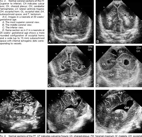 Figure 3 from Posterior fontanelle sonography: an acoustic window into ...