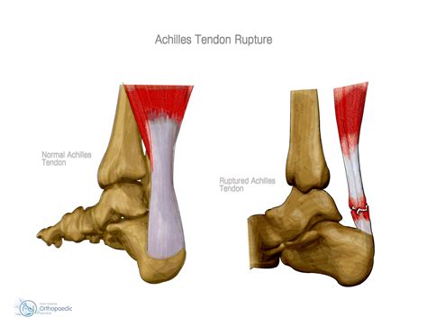 Achilles Tendon Rehab - Viewing Gallery