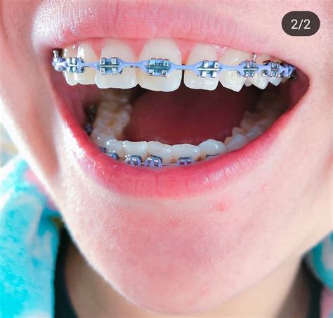 clear braces with colored rubber bands - Gaudy Cyberzine Stills Gallery