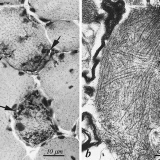 Morphological features of hereditary inclusion body myopathy in one ...