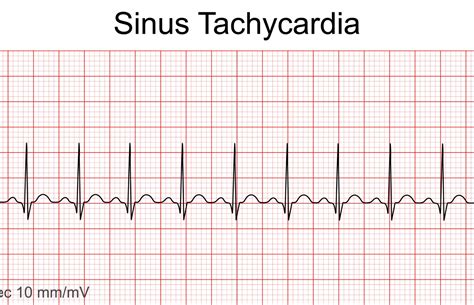 VA Disability Rating for Sinus Tachycardia | Berry Law