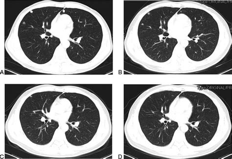 (A) The lung metastases before SHR-1210 treatment (July 23, 2017). (B ...