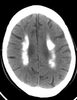 Basal Ganglia Calcification-Differential Diagnosis - Sumer's Radiology Blog