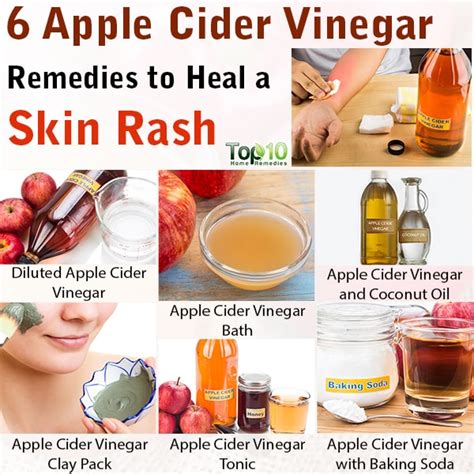 6 Apple Cider Vinegar Remedies to Heal a Skin Rash | Top 10 Home Remedies