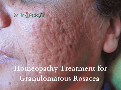 Homeopathy Treatment for Granulomatous Rosacea