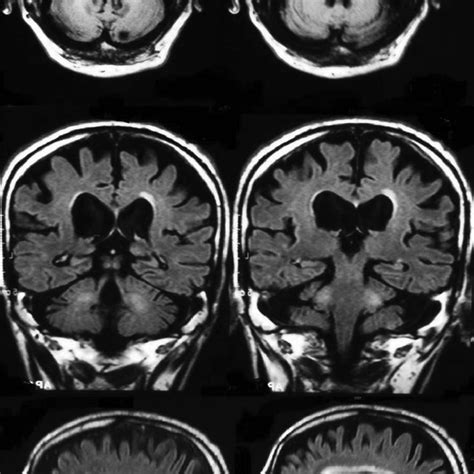 Cranial MRI showing generalized cerebral atrophy and increased T2 ...