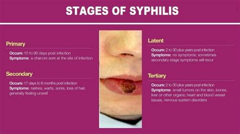 Syphilis Infection, Symptoms and Stages - Helal Medical