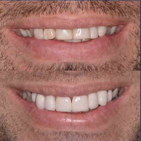 Veneers - Veneers