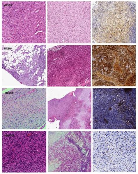 Histological and immunophenotypical features of MESO3, MESO4, MESO7 ...