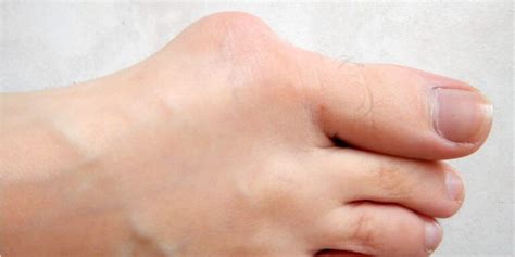 Bunions Causes And Natural Treatment | Baron Active