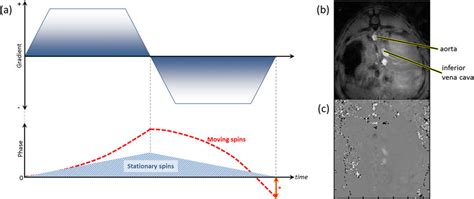 Phase-contrast MRI-(a) schematic diagram of sequence and (b, c) example ...