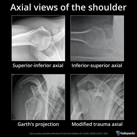 X Ray Shoulder Anatomy