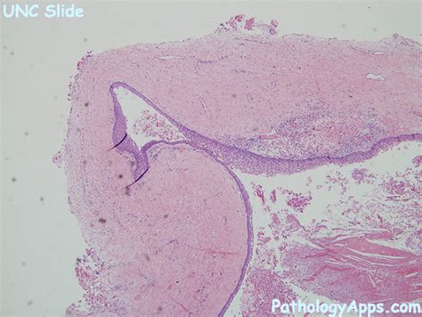 Dentigerous Cyst Histology