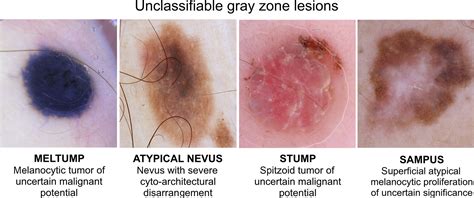 Junctional Melanocytic Nevus