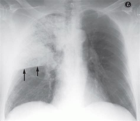 Lobar Pneumonia Chest X Ray Findings - malayelly