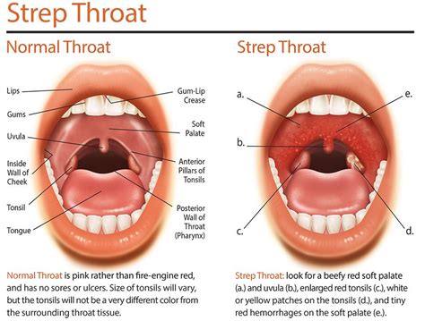 Canker Sore On Tongue, Canker Sore Relief, Canker Sore Causes, Canker ...