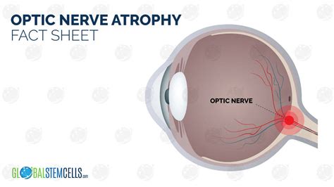 Patient's Improvements after Treatment for Optic Nerve Atrophy | GSC