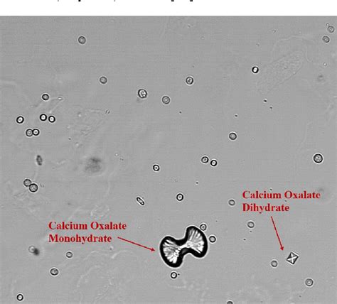 Calcium Oxalate In Urine