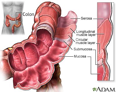 Colon cancer Information | Mount Sinai - New York